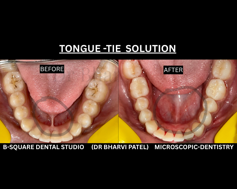 Small tissue . Big impact . Frenectomy  the procedure that frees yours smile and your speech